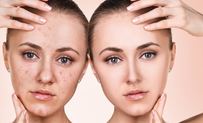 Skincerity Acne Treatment Reviews – Should You Trust This Product?